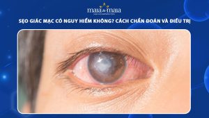 sẹo giác mạc có nguy hiểm không