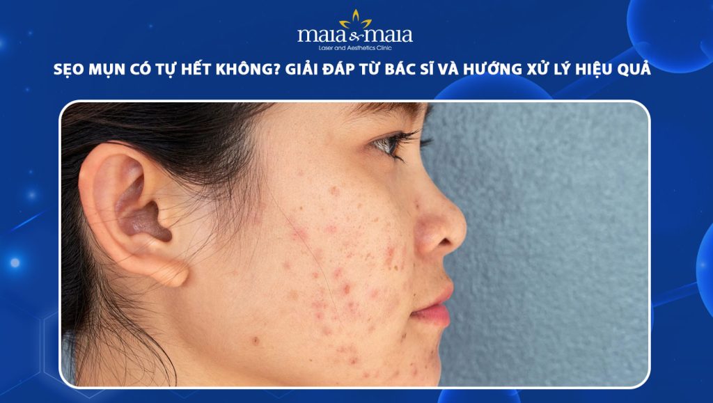 Sẹo mụn có tự hết không? giải đáp từ bác sĩ và hướng xử lý hiệu quả 1 sẹo mụn có tự hết không