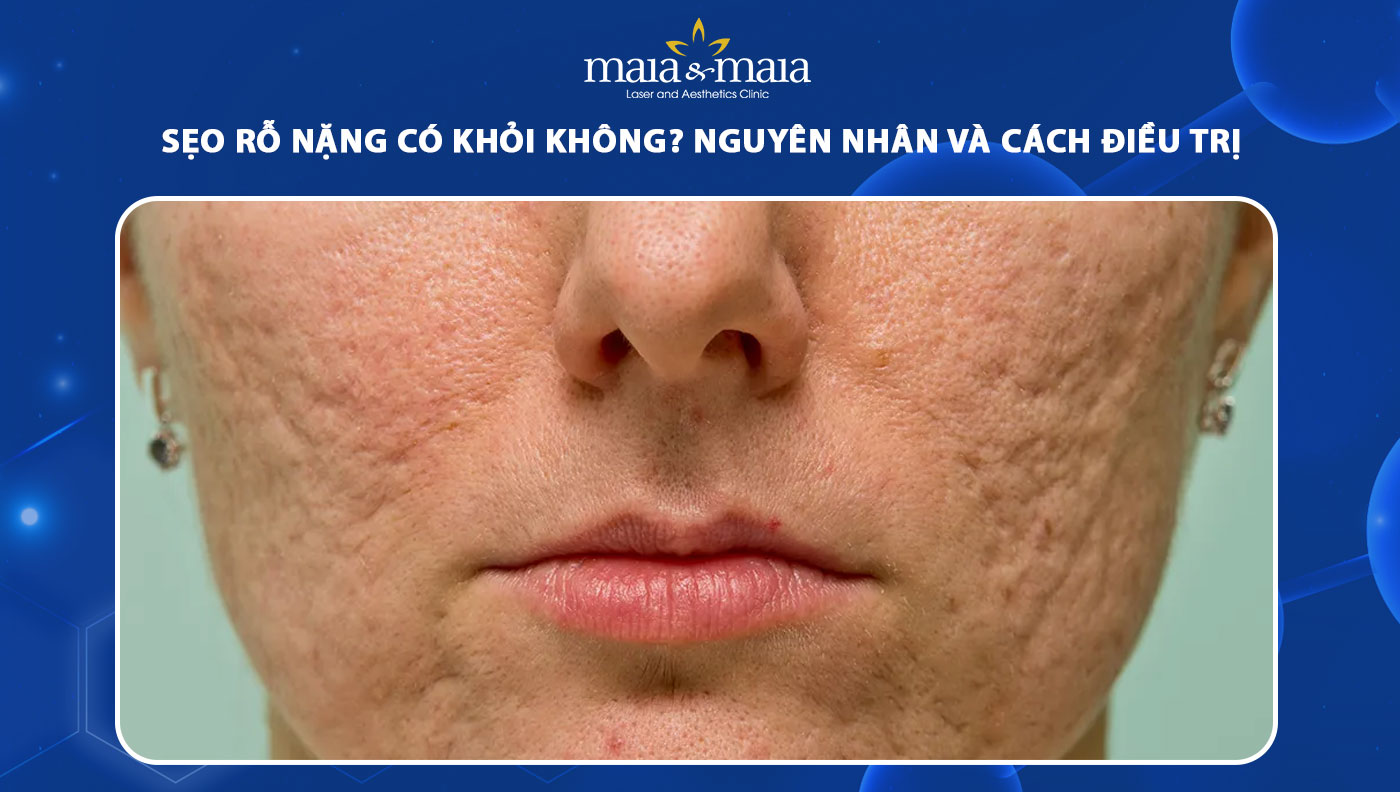 sẹo rỗ nặng