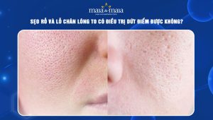 sẹo rỗ và lỗ chân lông to