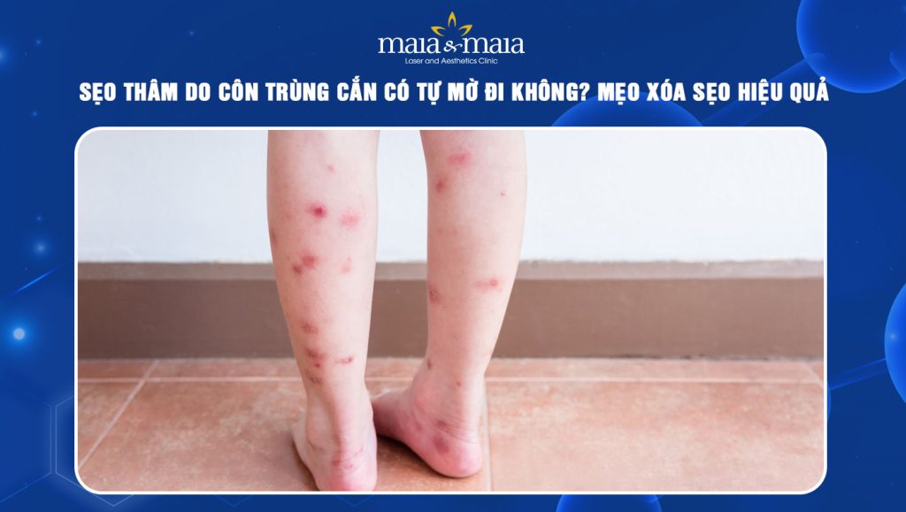 sẹo thâm do côn trùng cắn
