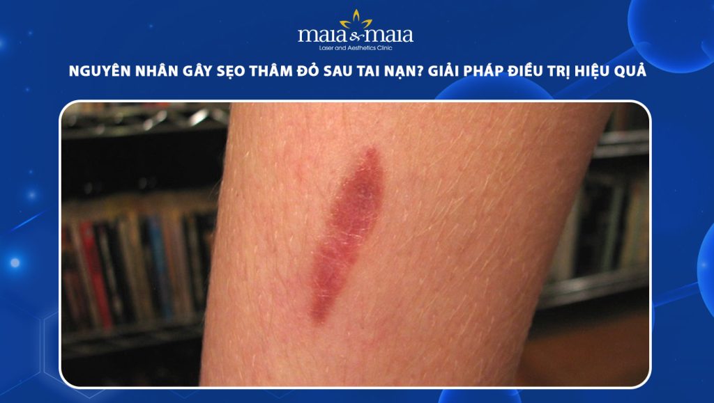 sẹo thâm đỏ sau tai nạn
