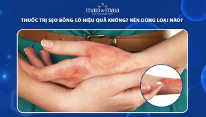 thuốc trị sẹo bỏng