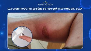 thuốc trị sẹo bỏng bô