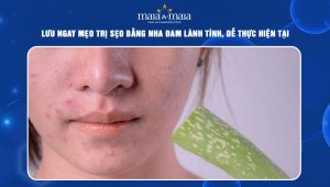 trị sẹo bằng nha đam