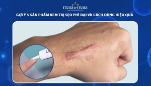 kem trị sẹo phì đại