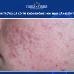 mụn trứng cá có tự khỏi không
