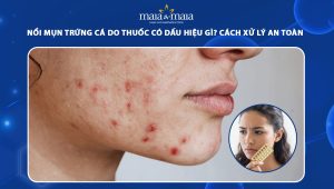 mụn trứng cá do thuốc