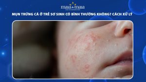 mụn trứng cá ở trẻ sơ sinh