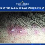 mụn trứng cá trên da đầu