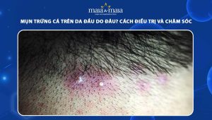 mụn trứng cá trên da đầu