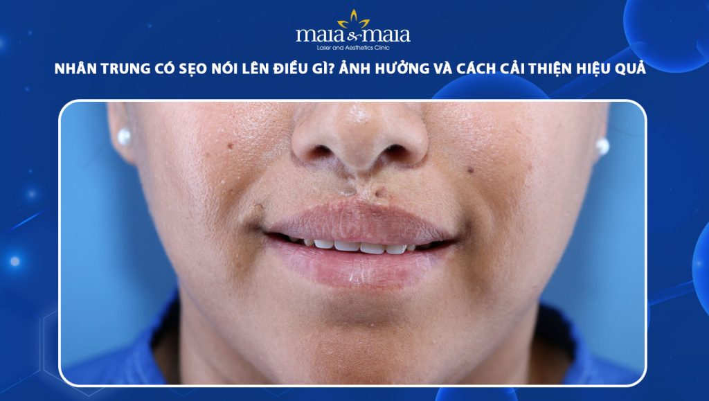 nhân trung có sẹo
