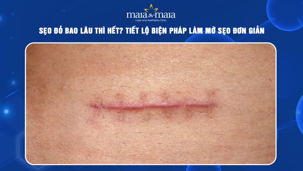 Sẹo đỏ bao lâu thì hết? Tiết lộ biện pháp làm mờ sẹo đơn giản 1 sẹo đỏ bao lâu thì hết