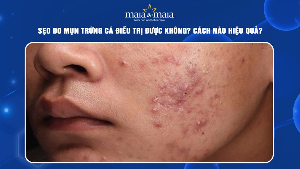 sẹo do mụn trứng cá