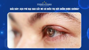 sẹo phì đại sau cắt mí