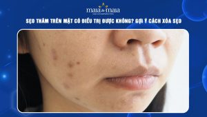sẹo thâm trên mặt
