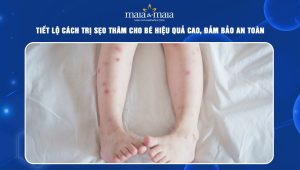 trị sẹo thâm cho bé