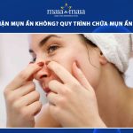 có nên nặn mụn ẩn không