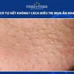 mụn ẩn có tự hết không