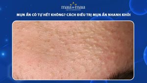 mụn ẩn có tự hết không