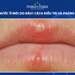 mụn nước ở môi