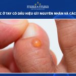 mụn nước ở tay