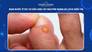 mụn nước ở tay