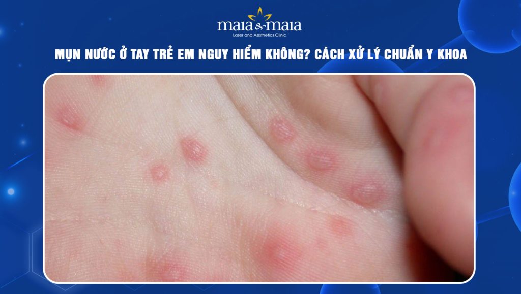 mụn nước ở tay trẻ em