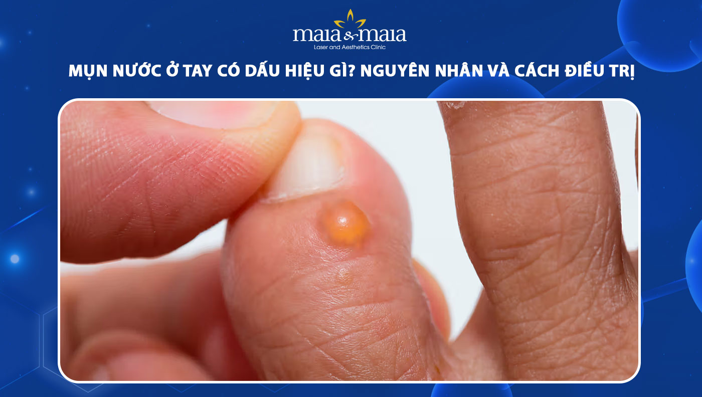 mụn nước ở tay