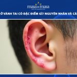 mụn nước ở vành tai