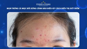 mụn trứng cá mọc đối xứng