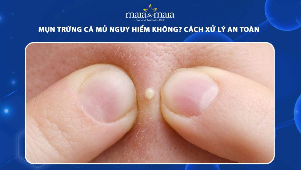 mụn trứng cá mủ