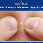 mụn trứng cá mủ