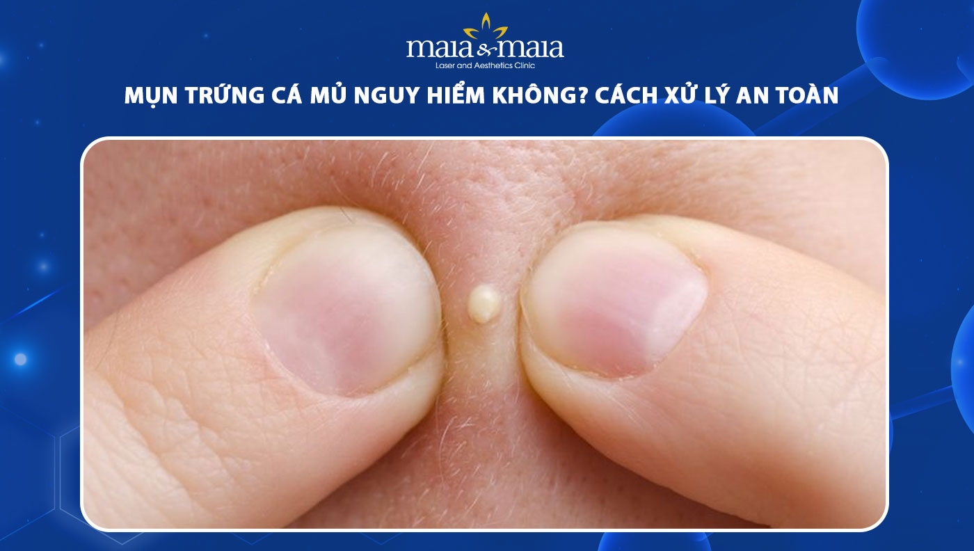 mụn trứng cá mủ