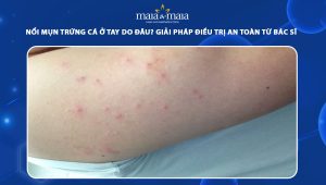 mụn trứng cá ở tay