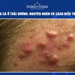 mụn trứng cá ở thái dương