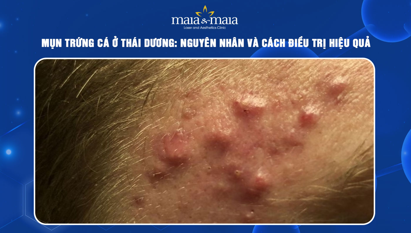 mụn trứng cá ở thái dương