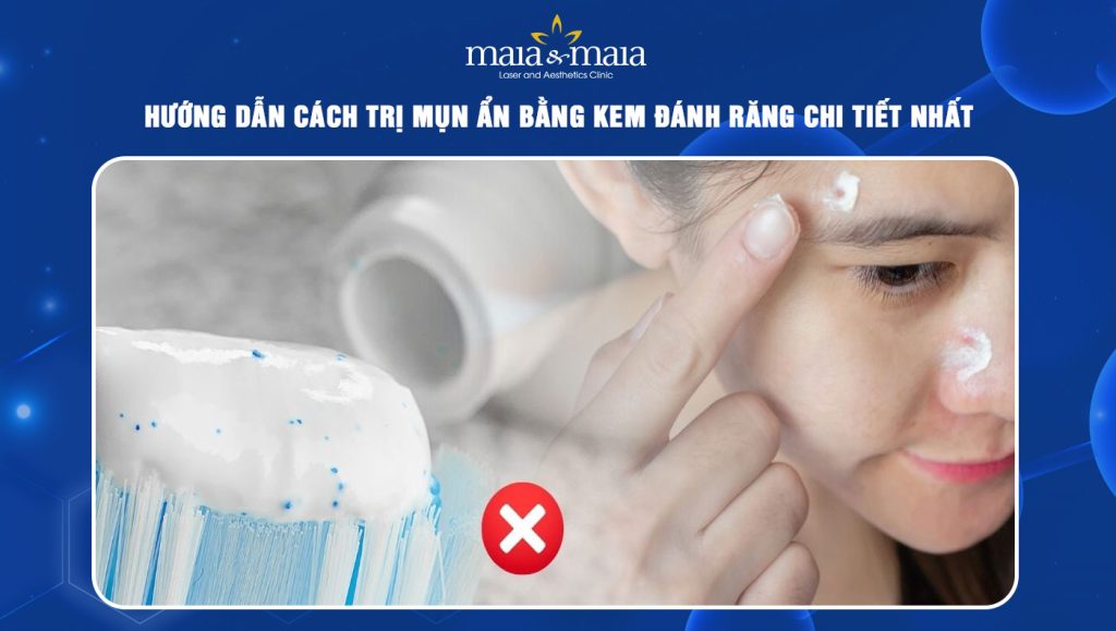 trị mụn ẩn bằng kem đánh răng