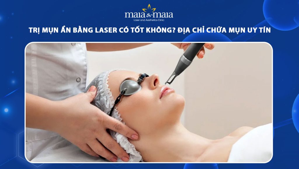 trị mụn ẩn bằng laser