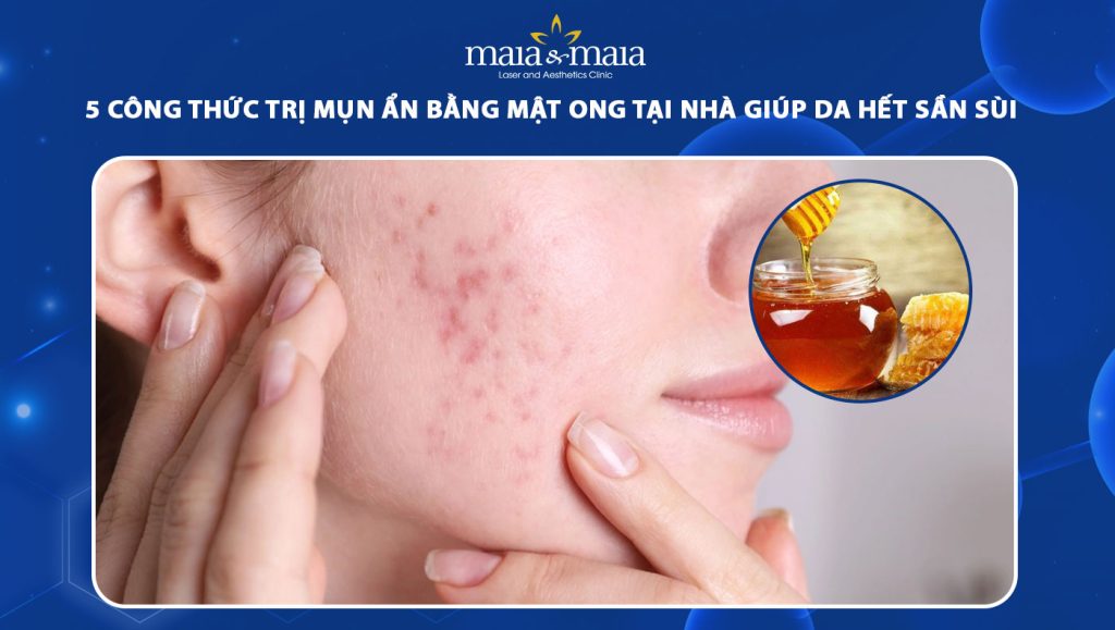 trị mụn ẩn bằng mật ong
