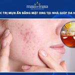 trị mụn ẩn bằng mật ong