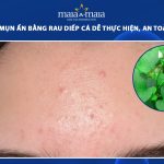 trị mụn ẩn bằng rau diếp cá