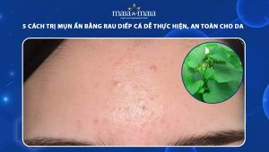 trị mụn ẩn bằng rau diếp cá