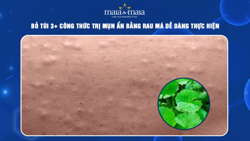 trị mụn ẩn bằng rau má