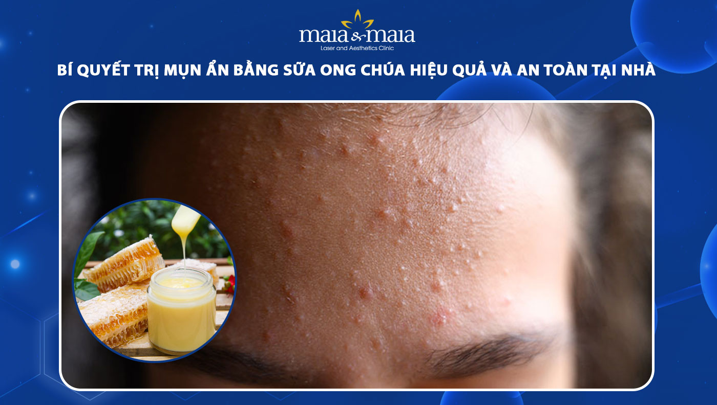 trị mụn ẩn bằng sữa ong chúa