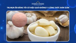 trị mụn ẩn bằng tỏi