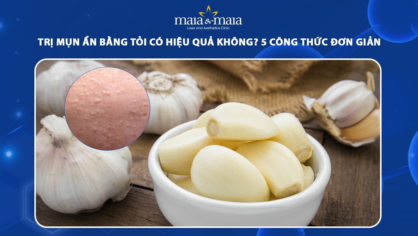 trị mụn ẩn bằng tỏi