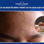 trị mụn ẩn bằng trứng gà
