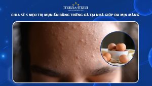 trị mụn ẩn bằng trứng gà