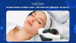trị mụn trứng cá bằng laser